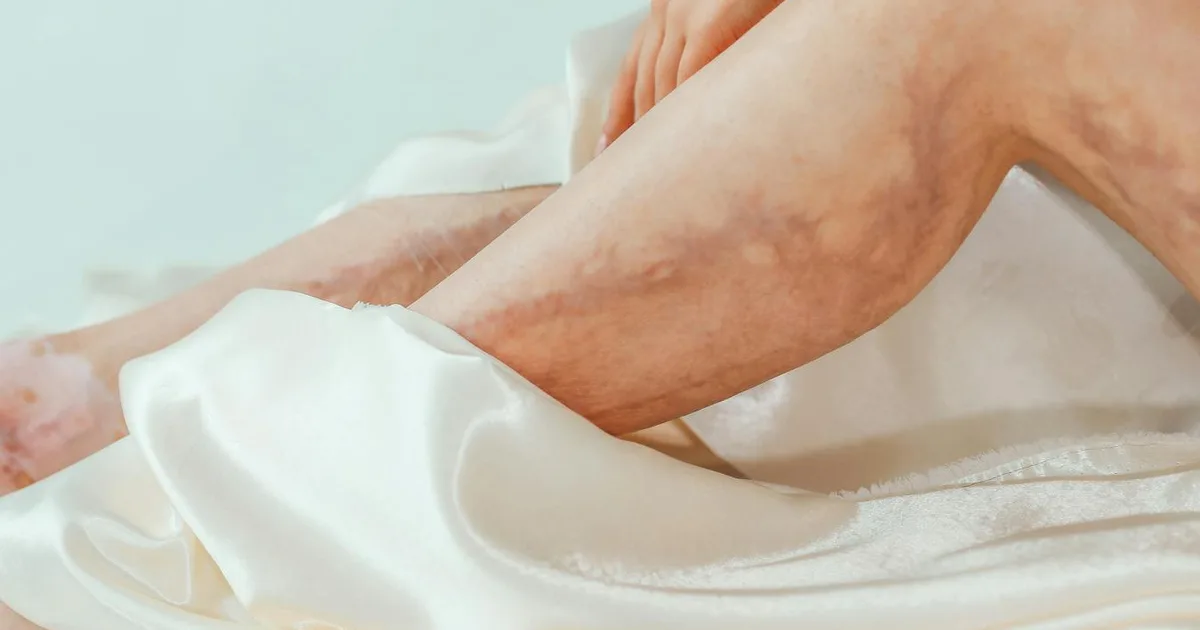 A close-up view of a woman's legs with varicose veins wrapped in a luxurious satin blanket. Health and skincare concept.