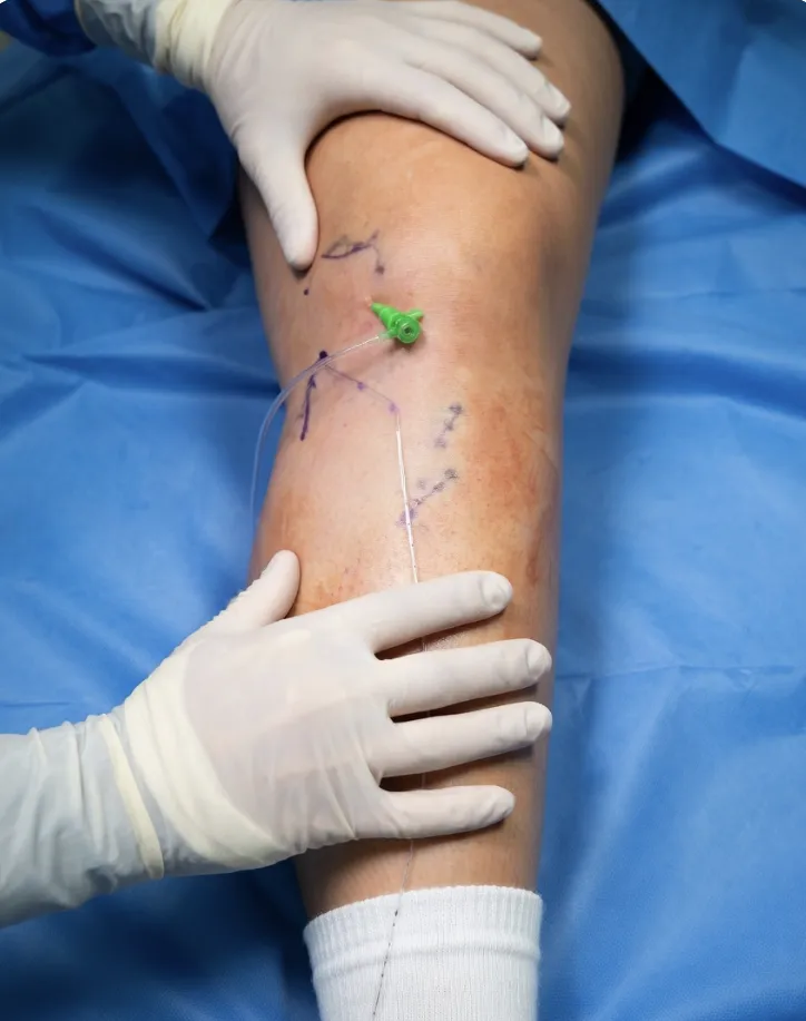 Endovenous laser ablation procedure showing catheter insertion into a leg vein with ultrasound-guided markings on sterile surgical drape